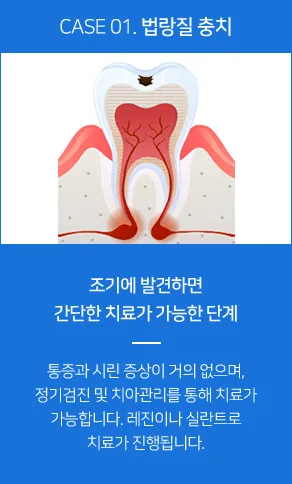 법랑질 충치