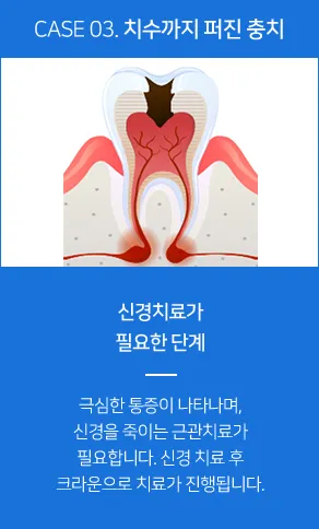 치수까지 퍼진 충치