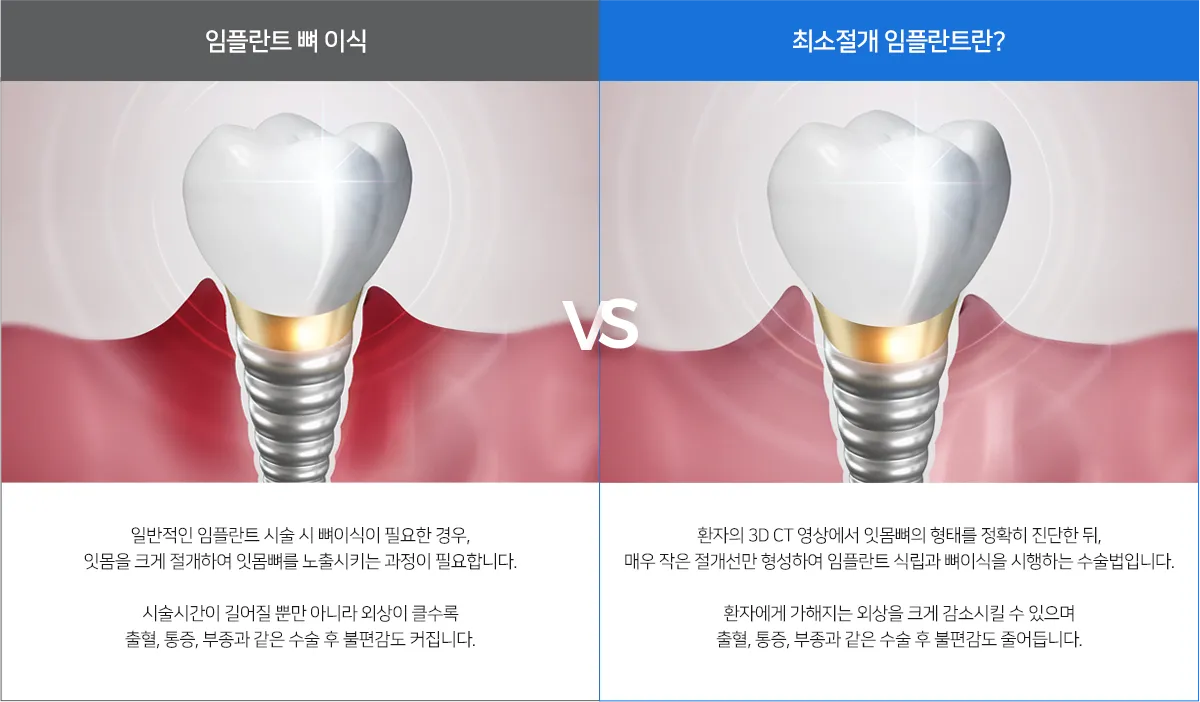 최소절개 임플란트 전후