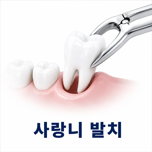 사랑니발치